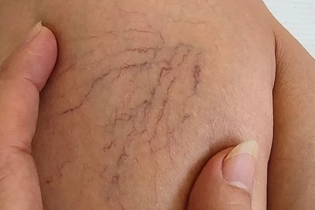 Consecuencias de las Várices y Cómo los Suplementos Pueden Ayudar