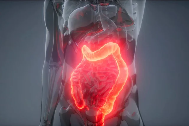 Tratamientos para el Colon Irritable