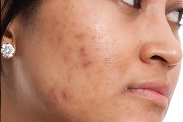 Tratamientos Naturales para el Acné